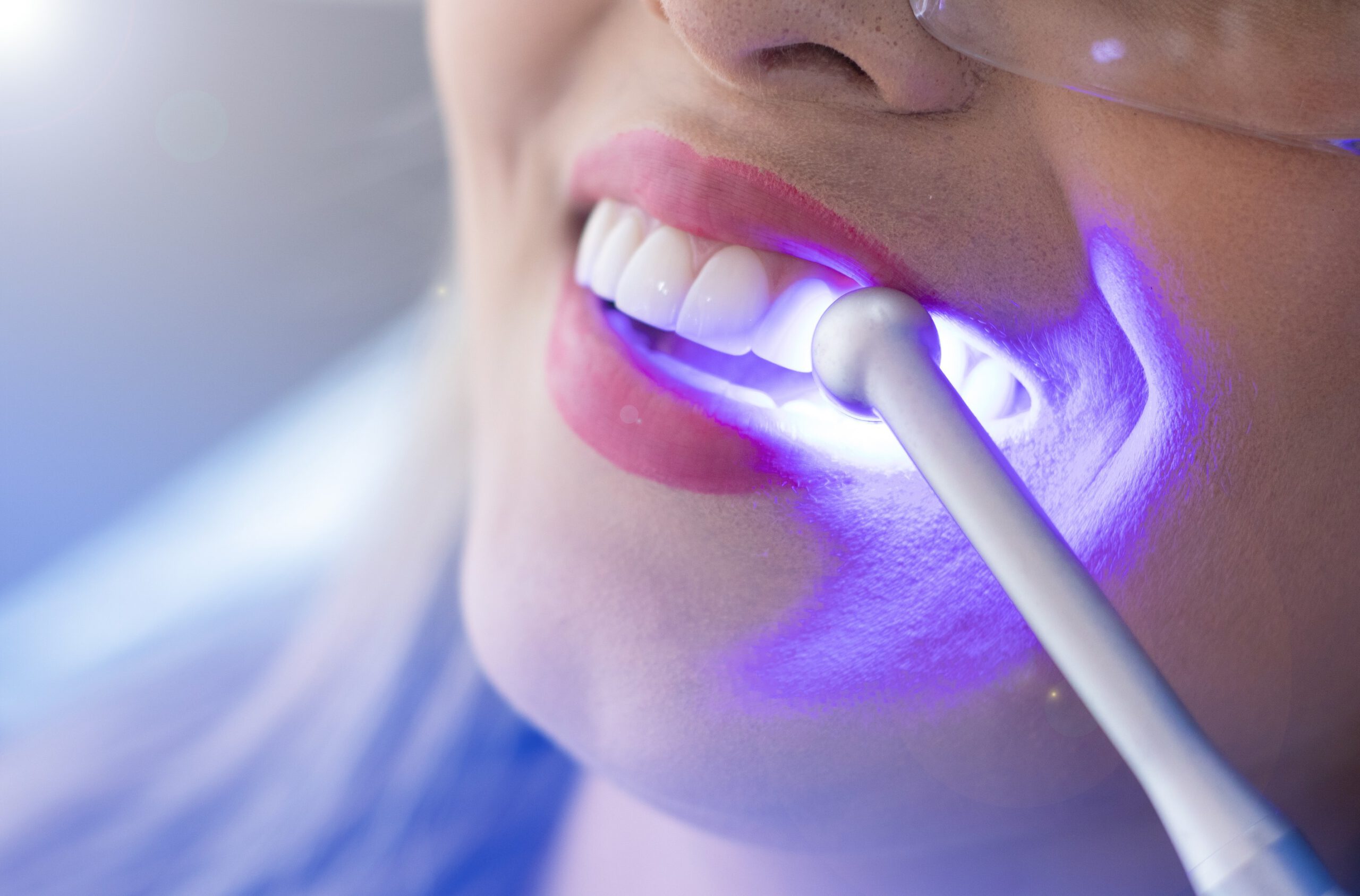 Imagen de Cuanto dura blanqueamiento dental
